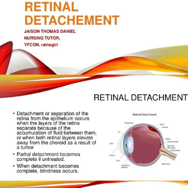 What Does Rational Detachment Mean