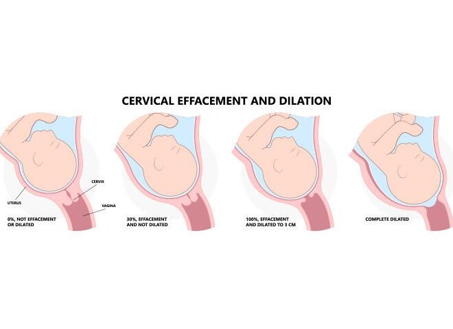 What Does -2 Station Mean When Checking Cervix