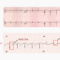 What Does An Abnormal Ecg Mean