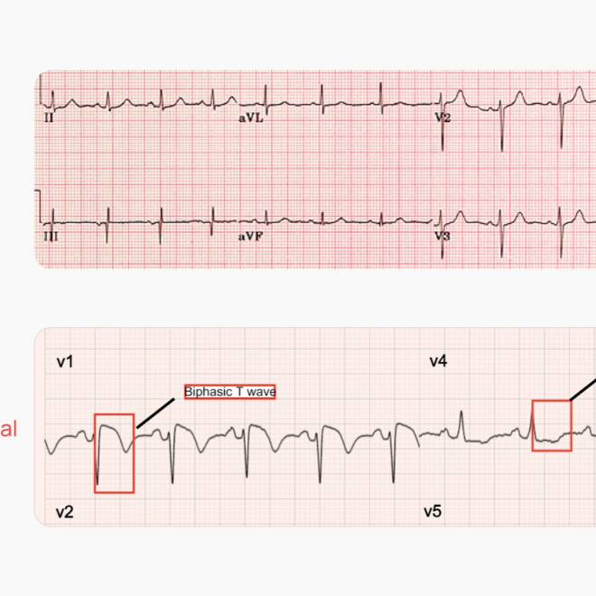 What Does An Abnormal Ecg Mean