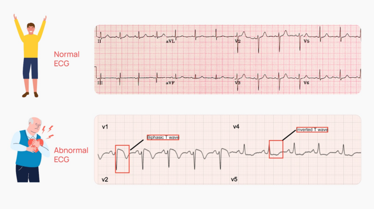 What Does An Abnormal Ecg Mean