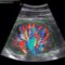What Do Colors Mean On An Ultrasound