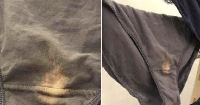 What Does A Bleach Stain In Your Underwear Mean
