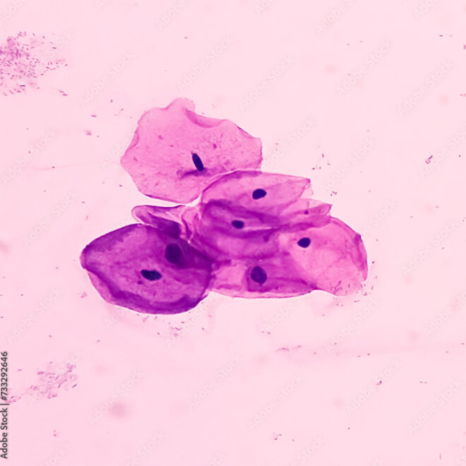 What Does Reactive Cellular Changes Mean On A Pap Smear