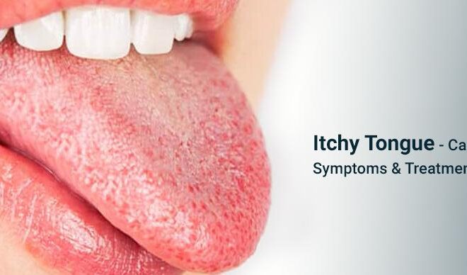 What Does It Mean When Your Tongue Is Itchy
