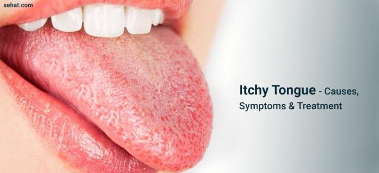 What Does It Mean When Your Tongue Is Itchy
