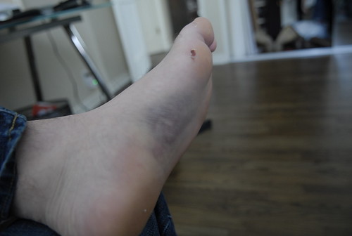 What Does It Mean When Your Foot Turns Purple