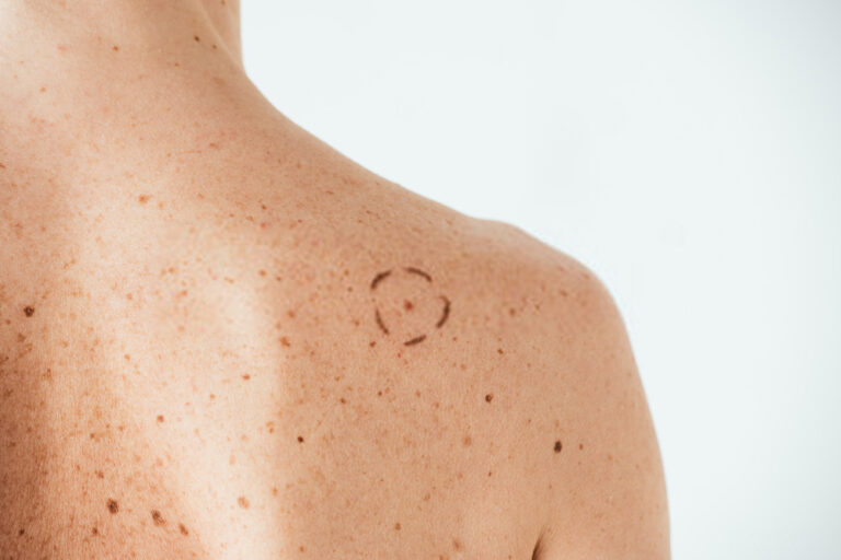 What Does It Mean If Your Moles Itch
