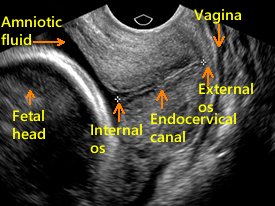 What Does It Mean To Have A Shallow Cervix