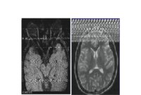 What Does It Mean When An Mri Shows An Artifact