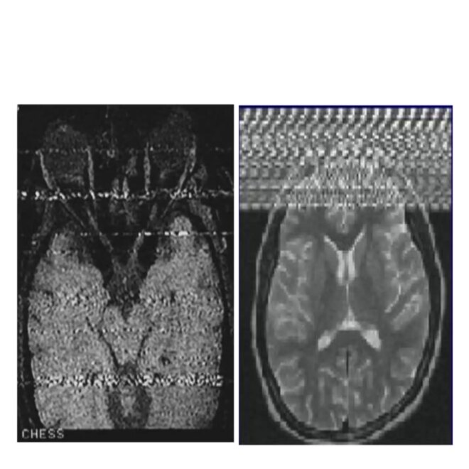 What Does It Mean When An Mri Shows An Artifact