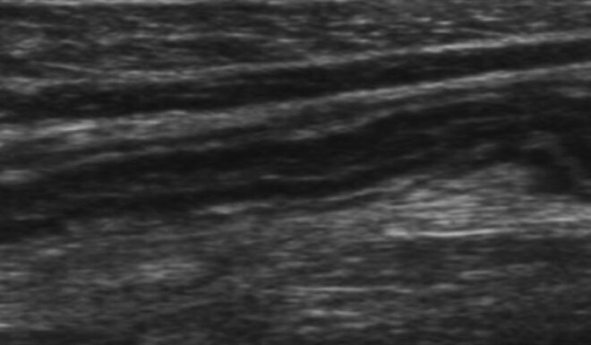 What Does It Mean When Appendix Is Not Visualized