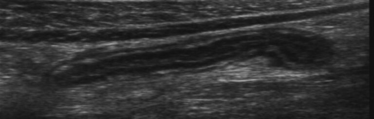 What Does It Mean When Appendix Is Not Visualized