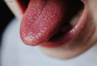 What Does Black Dots On Tongue Mean