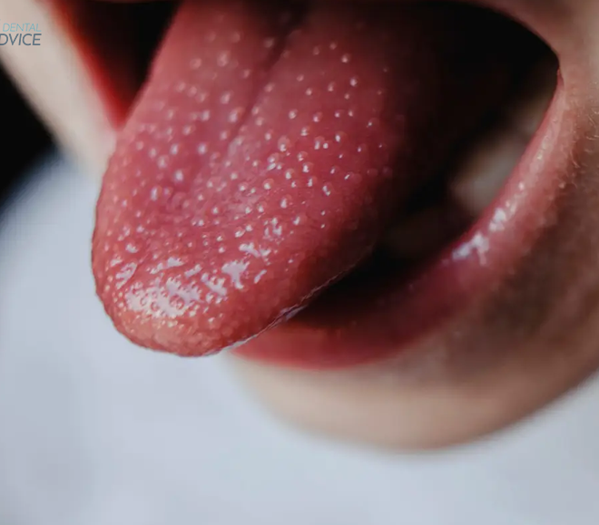 What Does Black Dots On Tongue Mean