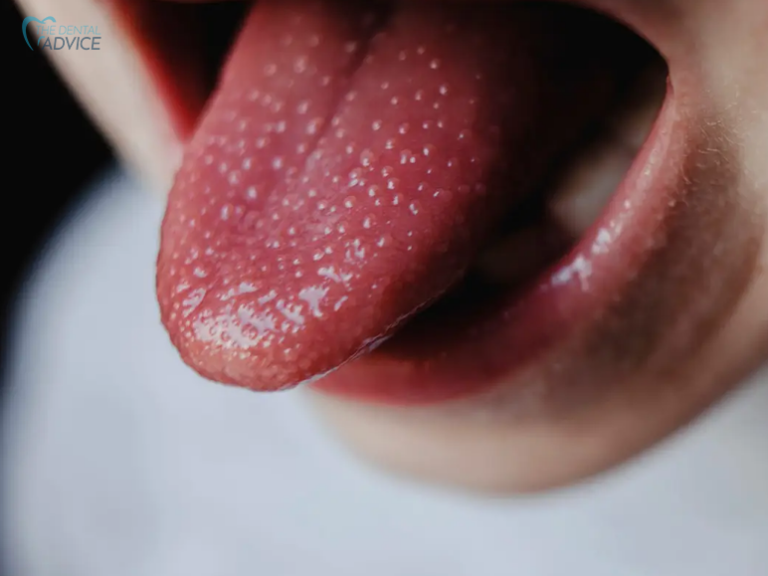What Does Black Dots On Tongue Mean