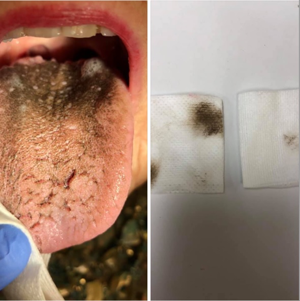 What Do Black Spots On The Tongue Mean