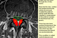 What Does Mass Effect On Thecal Sac Mean