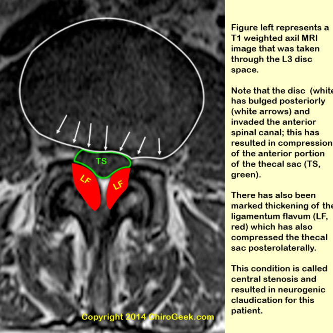 What Does Mass Effect On Thecal Sac Mean