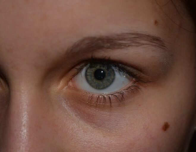 What Do Birthmarks Mean In The Bible