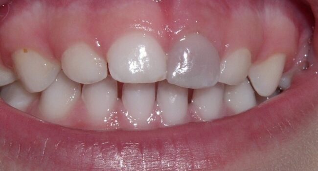 What Does A Grey Tooth Mean