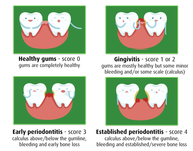 What Does A Gum Score Of 4 Mean