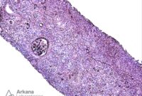 What Does Igg P41 Ab Present Abnormal Mean