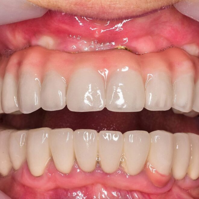 What Does Per Arch Mean In Dental Implants