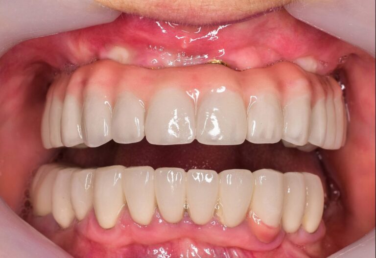 What Does Per Arch Mean In Dental Implants