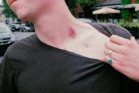 What Does A Hickey Mean To A Guy