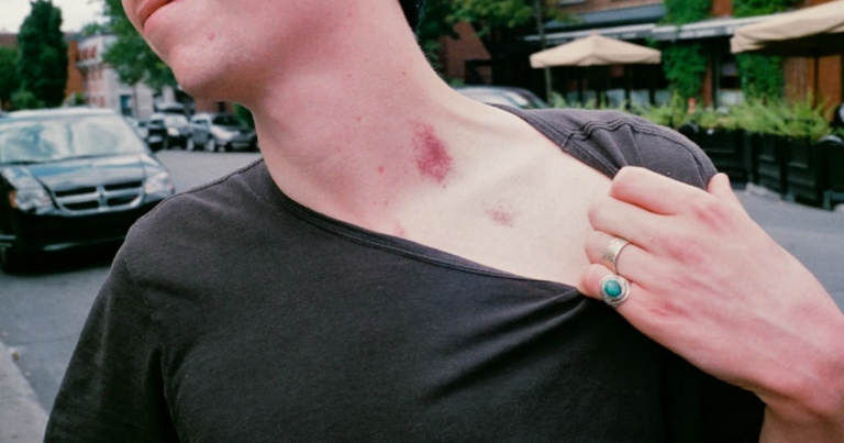 What Does A Hickey Mean To A Guy