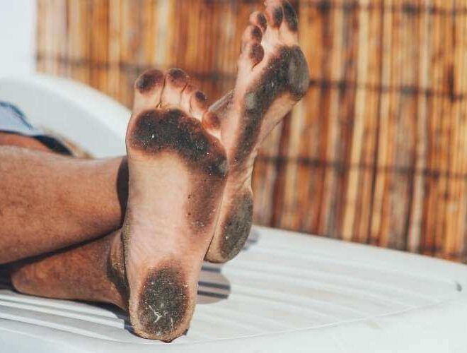 What Does It Mean When Your Feet Turn Black