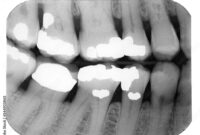 What Do Cavities Look Like on an X-Ray? Dental Images Decoded