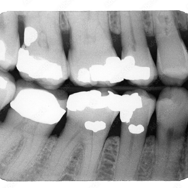 What Do Cavities Look Like on an X-Ray? Dental Images Decoded