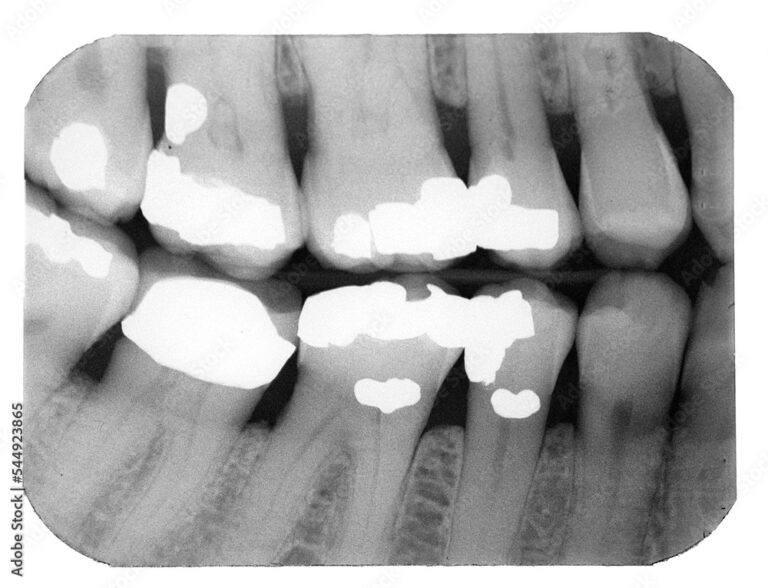 What Do Cavities Look Like on an X-Ray? Dental Images Decoded