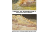 What Do Fascia Adhesions Feel Like? Symptoms Causes and Relief Options