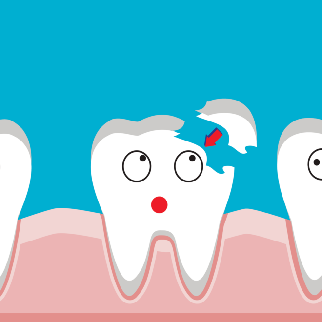 What Do You Do If You Chip Your Tooth? Immediate Steps and Dental Care