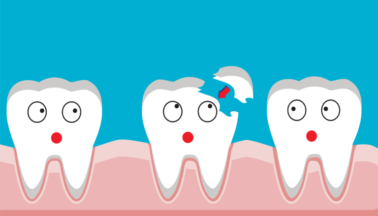 What Do You Do If You Chip Your Tooth? Immediate Steps and Dental Care