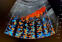What Do Colors Mean on Ultrasound? Doppler Imaging Decoded