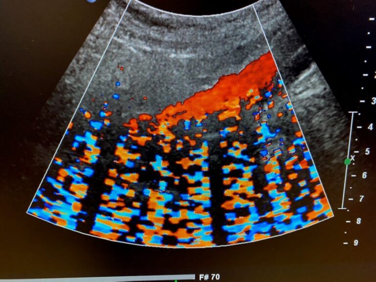 What Do Colors Mean on Ultrasound? Doppler Imaging Decoded