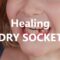 What Do I Do for a Dry Socket? Fast Relief and Healing Tips