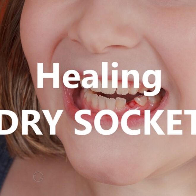 What Do I Do for a Dry Socket? Fast Relief and Healing Tips