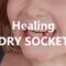 What Do Dry Sockets Look Like? Visual Signs and Healing Tips