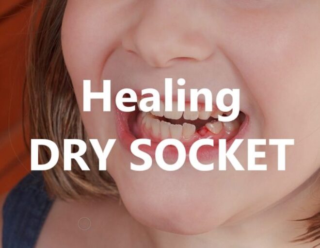 What Do Dry Sockets Look Like? Visual Signs and Healing Tips