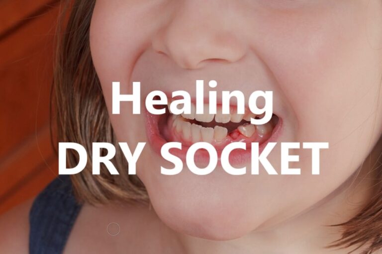 What Do I Do for a Dry Socket? Fast Relief and Healing Tips