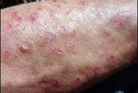 What Do Meth Sores Look Like? Warning Signs and Health Risks