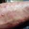 What Do Meth Sores Look Like? Warning Signs and Health Risks