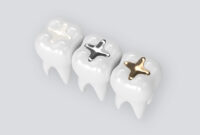What Do Cavity Fillings Look Like? Types Colors and Materials