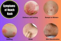 What Does a Roach Bite Look Like? Symptoms Photos and Treatment Tips
