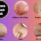 What Does a Roach Bite Look Like? Symptoms Photos and Treatment Tips